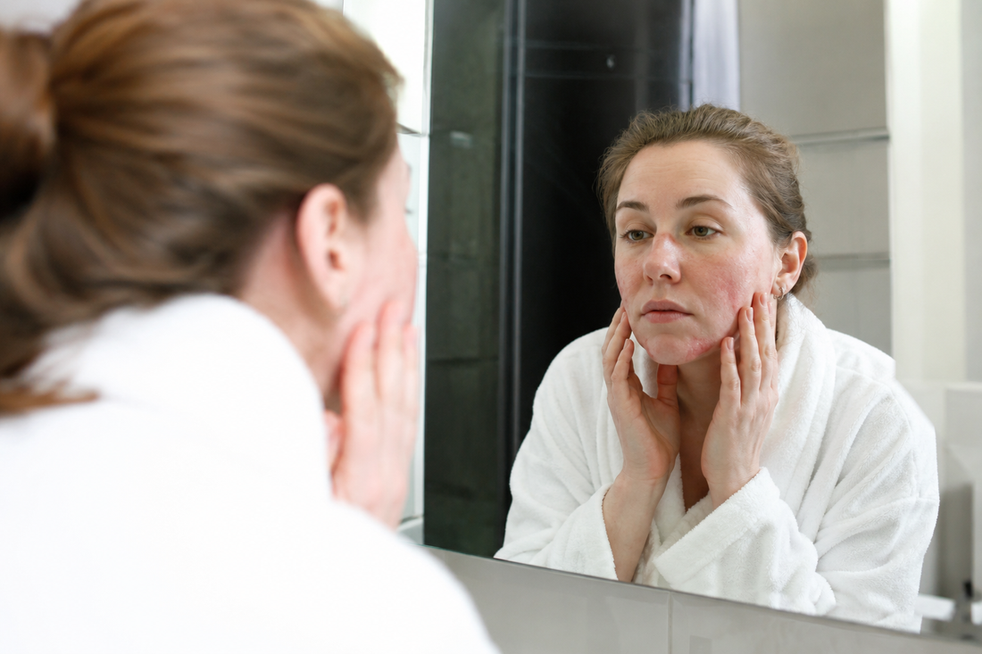 Dermatitis im Gesicht mit geröteter, gereizter und empfindlicher Haut – typische Symptome einer entzündlichen Hautreaktion