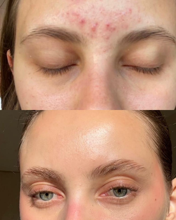 Clear Skin Komplett