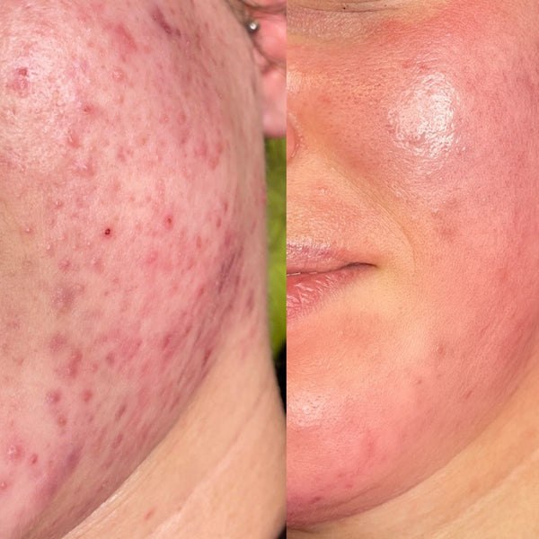 Clear Skin Komplett